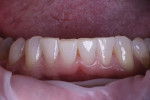 Pretreatment close-up photograph of the mandibular anterior teeth prior to establishing the new bonded incisal edges.