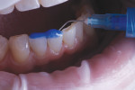 Once the teeth were prepared, an etchant (Select HV® Etch w/BAC, BISCO, Inc) was applied.