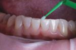 Next, a bonding agent (Prime & Bond® NT, Dentsply) was applied and cured.