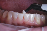Composite (Filtek™ Supreme Ultra [B1B], 3M) was then carefully placed into the preparations and sculpted.