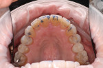 Maxillary occlusal view demonstrating smooth transitions for laterotrusive and protrusive movements.