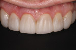 At the end of the first appointment, the maxillary anterior composite veneers had the rough shape and form required, but the patient was instructed to test the newly proposed esthetic design and return for any necessary adjustments before final finishing.