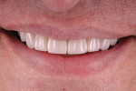 Posttreatment smile photograph of the completed minimally invasive smile transformation with composite resin demonstrating a stable occlusal scheme.