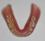 Images of the cameo surfaces of the patient’s existing maxillary and mandibular dentures, respectively, clearly exhibiting wear of the denture teeth and the prosthetic bases.