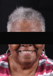 Full-face portrait of the patient’s smile with her existing dentures.