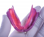 The existing mandibular denture was used as a custom tray to capture the final impression of the patient’s mandibular arch using medium body material.