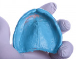 The existing maxillary denture was used as a custom tray to create the final impression of the patient’s maxillary arch using light body material.