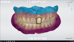 Screenshot of the maxillary and mandibular bite scans in the design software.