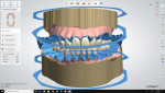 The final dentures were designed using the system’s bicolored discs.