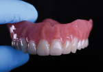 The maxillary denture was characterized with a composite material.
