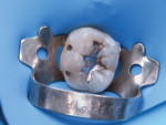 Tooth No. 30 fully isolated and ready for amalgam removal.