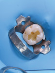 Occlusal view of the preparation after removal of the amalgam and residual decay.