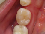 Occlusal view of the final restorations (after finishing and polishing) completed with a single-shade universal composite.