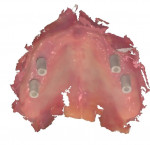 Fig 4. The maxillary arch scan with scan flags.