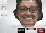 Fig 5. The denture setup is shown in a 3D rendering of the patient’s face from a 3D face scan.