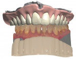 Fig 6. The final design of the denture.