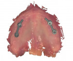 Fig 9. The maxillary arch scan with bars designed in the software.