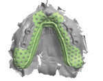 Fig 10. The maxillary arch scan with the designs of both the bars and the RPD framework.