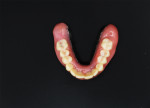 Fig 18. The final denture after milling from a monolithic block and assembly.