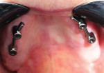 Fig 20. The milled bars are placed onto the implants in the patient’s mouth.