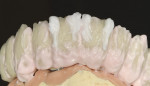 Figure 10  The dentin layer application.