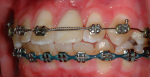 Fig 6. Conclusion of initial orthodontic treatment.