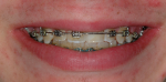 Fig 8. Orthodontic treatment was completed after a total of 8 years with the provisional bonded pontic replacing the maxillary left central incisor.