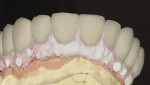Figure 12  Gingival tissue color application.