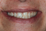 Fig 1. Front view, pretreatment. Patient was concerned about worn and chipped teeth and failing composite restorations.