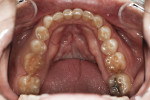 Fig 2. Maxillary dentition, occlusal view, pretreatment.