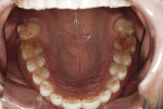 Fig 3. Mandibular dentition, occlusal view, pretreatment.