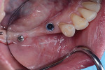 Fig 6. Implant No. 31 was placed lateral to the inferior alveolar nerve.