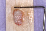 Fig 9. Free gingival graft from palate.