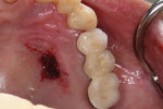 Fig 10. Palatal donor site.