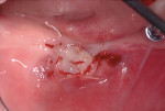 Fig 11. Free gingival graft adapted to recipient site.