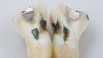 Fig 4. Same tooth as in Fig 3 after application of caries dye. Dye clearly penetrated into areas not indicative of caries.