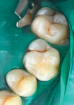 Fig 6. Intraoral view of teeth Nos. 13 through 15 under daylight. Brown discoloration of the fissures suggest further diagnosis.