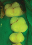 Fig 7. Same situation shown in Fig 6 as seen using FET; the red fluorescence indicates active caries. Need for surgical intervention is thus confirmed.