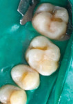 Fig 9. Caries removal performed with air abrasion.