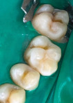 Fig 10. Same clinical situation as shown in Fig 9 from a different angle; brownish dentin that did not reveal active caries was preserved.