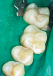 Fig 11. Prepared lesions were restored with composite resin.