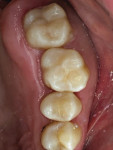 Fig 12. Postoperative intraoral view.