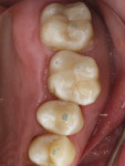 Fig 13. Final evaluation with occlusion-indicating film revealed no functional and occlusal contacts on the restorations.
