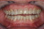 Fig 2. Pretreatment, retracted view. Note crowding and tooth wear.