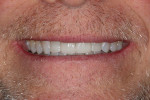 Fig 4. Post-treatment, patient’s smile. Note natural-looking, high-gloss finish.