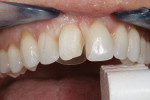 Fig 8. Isolation and preparation of tooth No. 8.