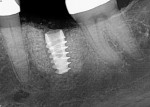 Fig 1. A 4.5-year buried implant showing bone loss.