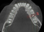 Fig 2. Sagittal view of CBCT of implant in Fig 1 showing trough bone loss.