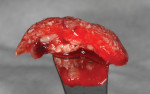 Fig 4. “Sticky” bone of L-PRF block with mineralized cancellous allograft.