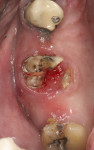 Fig 5. Fixed partial bridge sectioned and removed revealing severely decayed and hopeless tooth No. 3.